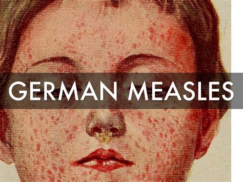 measles deutsch